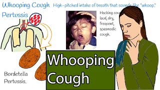 Whooping cough  Pertussis.  Hacking cough, Symptoms and treatment