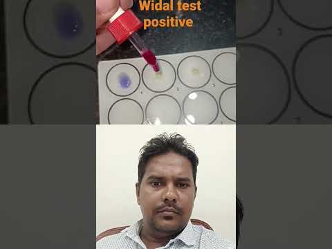 Widal Test Positive Widaltest Typhoid Widal Trending Trendingshorts Viral Viralvideo Shorts