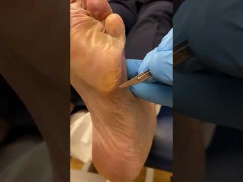 Watch as we give corns the boot Foot care never looked so relieving - tune in