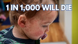 Measles Outbreak: CDC Warns of Spread, Urges Vaccination for Protection