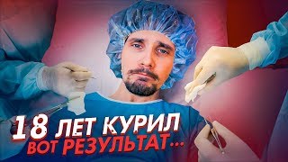 18 ЛЕТ КУРИЛ - ВОТ РЕЗУЛЬТАТ...