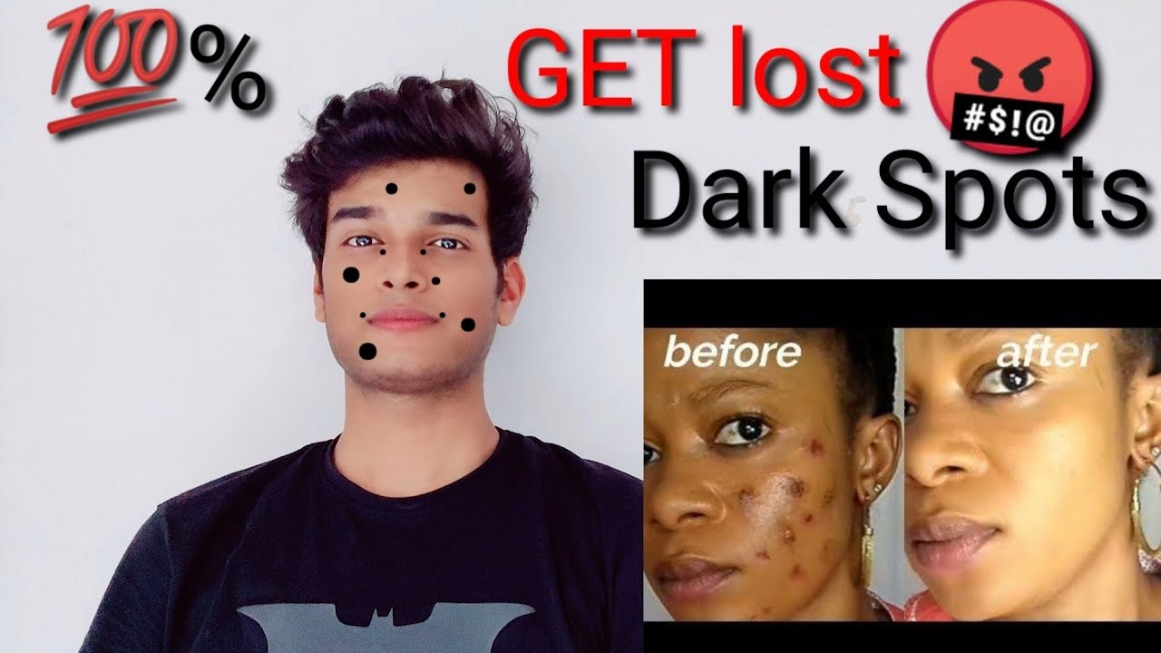 Homeopathic Medicine For Dark Spots On Face