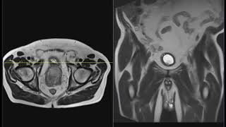 Benign prostatic hypertrophy and inguinal hernias