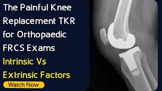 The Painful Knee Replacement TKR for Orthopaedic FRCS Exams | Intrinsic Vs Extrinsic Factors screenshot 3