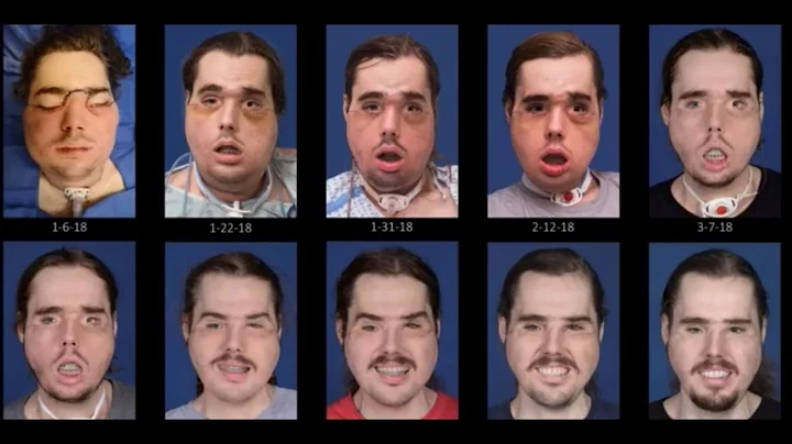 See the remarkable recovery progression of face tr...