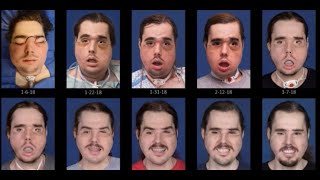 See the remarkable recovery progression of face transplant patient Cameron Underwood of Yuba City