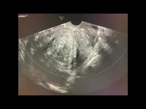 Embolización de Miomas Uterinos Dr. Rogelio Herrera Lima