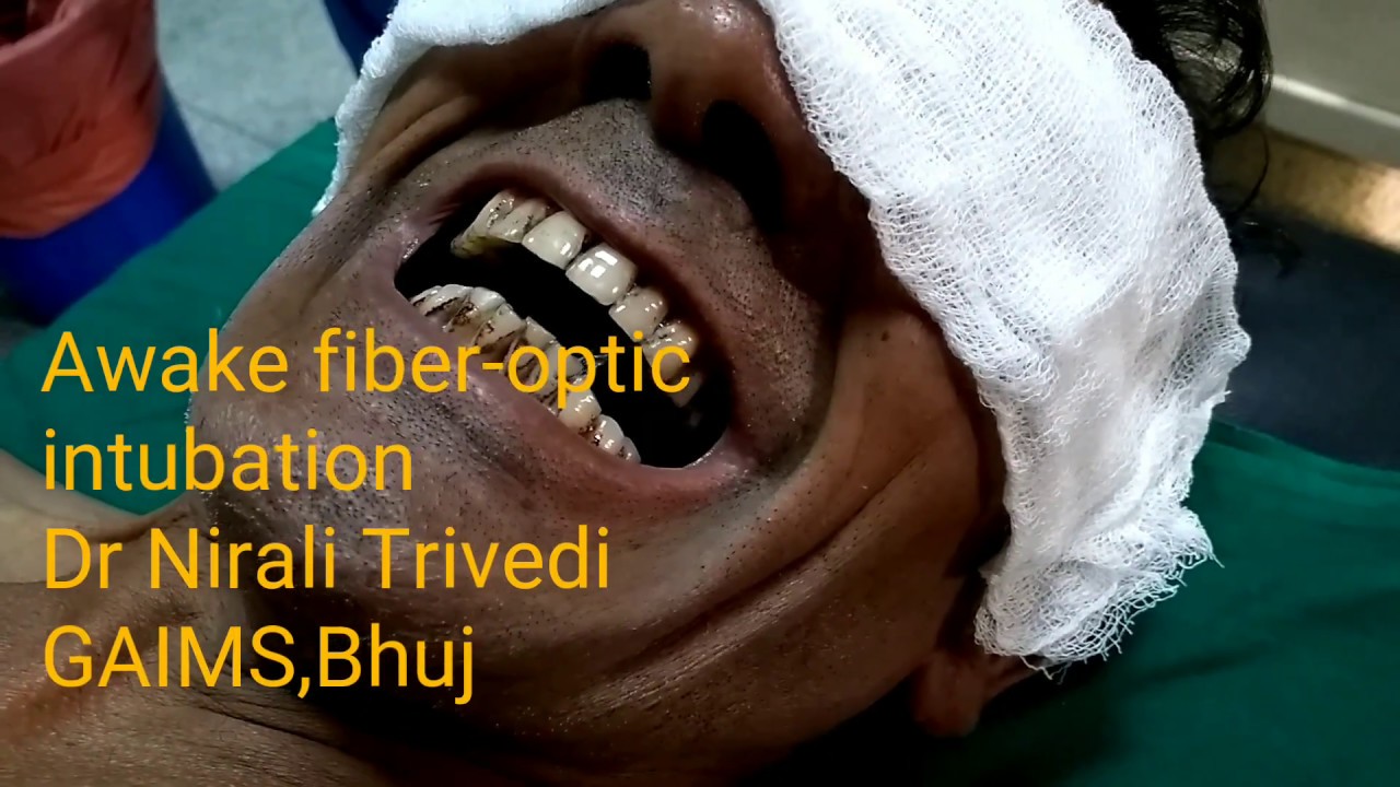 fiberoptic  New  Awake fiberoptic intubation,(Video-bronchoscope has been used.)