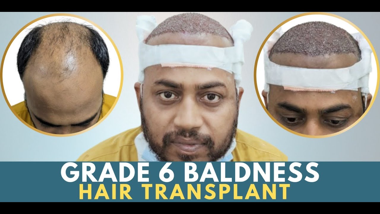 Hair transplant in jabalpur Best hair transplant results jabalpur YouTube