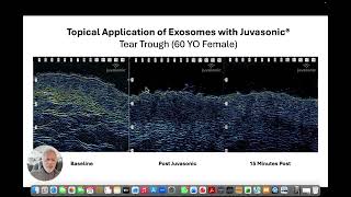 Can You See Topical Exosome Absorption? | Juvasonic Clinical Imaging | Dr. Sanjay Batra | March 2026