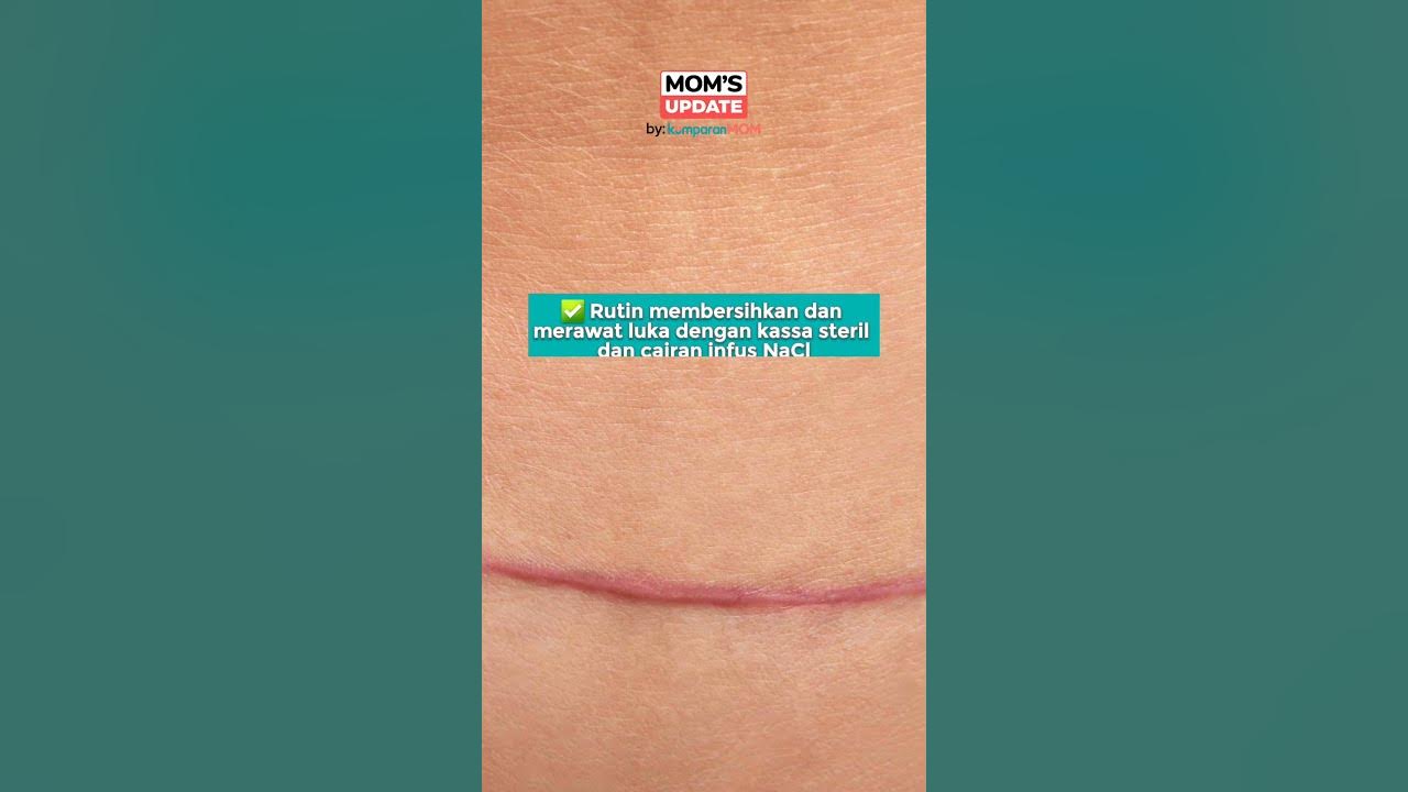 Merawat Bekas Jahitan Setelah Operasi Caesar - YouTube