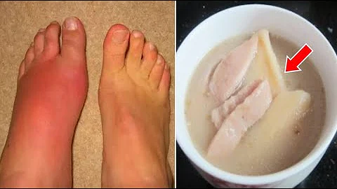 醫生警告：這食物打死都別碰！吃一口尿酸急速超標！嘌呤比海鮮高出40倍！小心痛風發作要你老命！ - 天天要聞