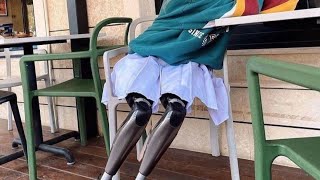 A Beautiful Amputee Woman Can Walk With Artificial Legs #Dak_Amputee