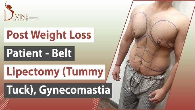 Post Weight Loss Patient Loss - Belt Lipectomy (Tummy Tuck)