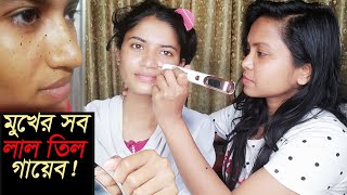 মুখের সব লাল তিল তুলে দিলাম ! How to Remove Red Moles । #jannatpramanikskincareroutine