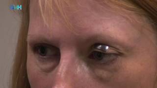 Using External Eyelid Weights In Facial Nerve Palsy