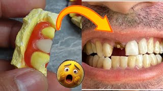 Make Your Own Dentures at Home (Step by Step Guide)