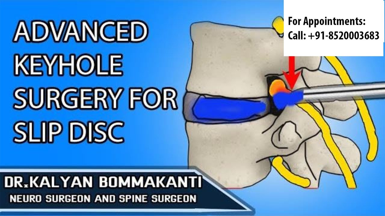 Современная малоинвазивная или эндоскопическая хирургия при грыже межпозвоночного диска. Доктор К...