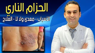 الحزام النارى | Herpes zoster | الأسباب ⁦👩‍🏫⁩ - الأعراض 🤒 - العلاج 👉 | معدى ولا لأ ؟! 😷