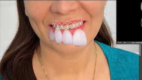 Bạn Sẽ Trông Như Thế Nào Sau Khi Ứng Dụng Công Nghệ DSD?