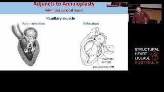 Latest surgical management of ischaemic mitral regurgitation. Fiona Schnitzler