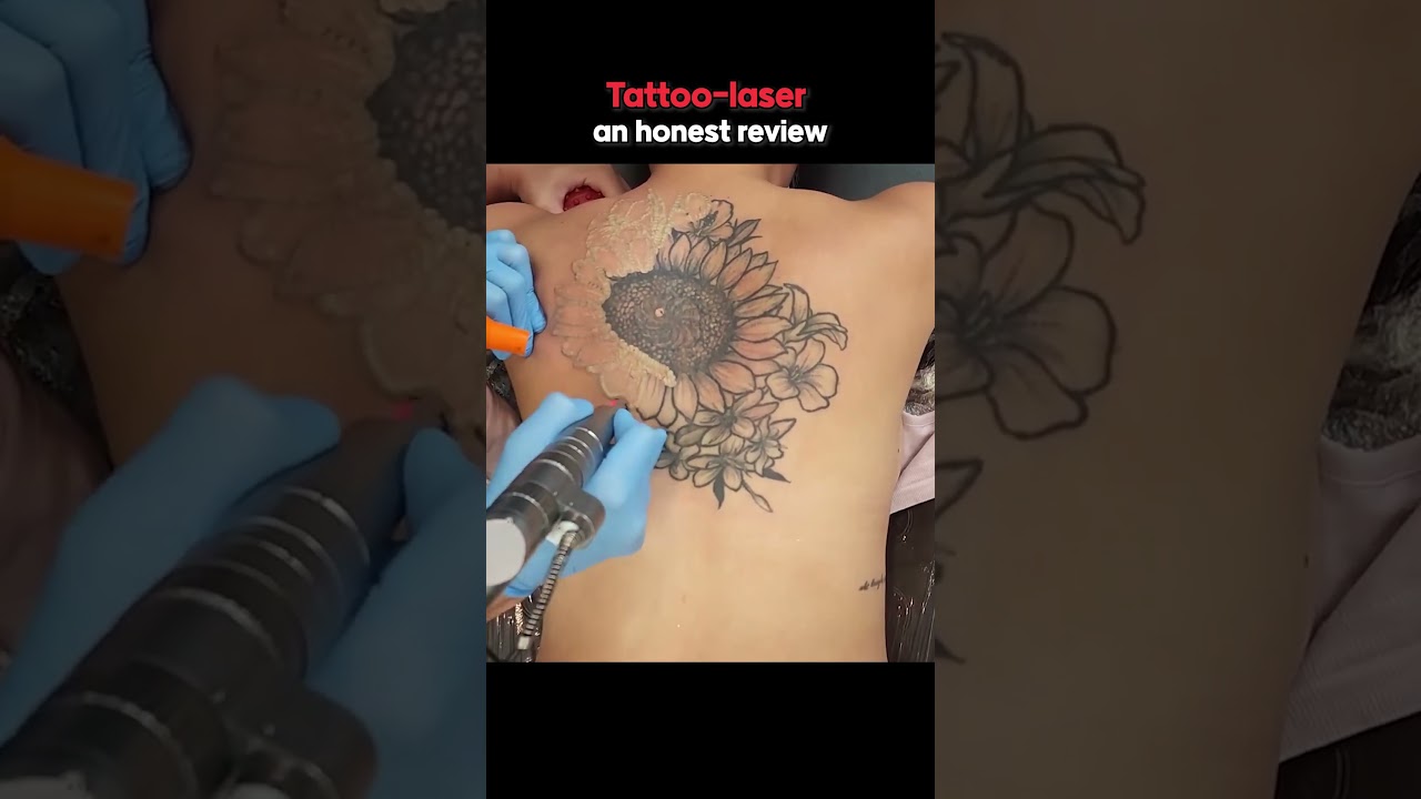 100% Tattoo Removal Possible? Watch This!