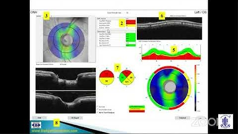 Dr Muralidhar - OCT in Glaucoma