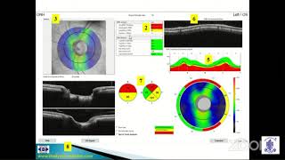 Dr Muralidhar - OCT in Glaucoma