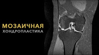 Мозаичная Хондропластика