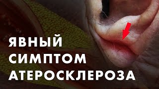 АТЕРОСКЛЕРОЗ И МОЧКА УХА. БЕЗОБИДНЫЙ ДЕФЕКТ ИЛИ ИЛИ СЕРЬЕЗНЫЙ СИМПТОМ | Клиника Online