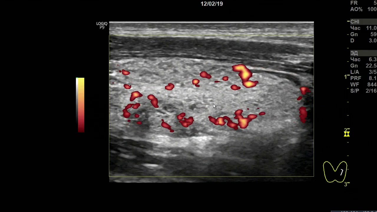 Клинический случай 6. (УЗИ Щитовидной Железы ) доктор А.В. Ушаков