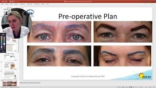 Eyebrow Hair Transplantation Presented by Dr. Sara Wasserbauer