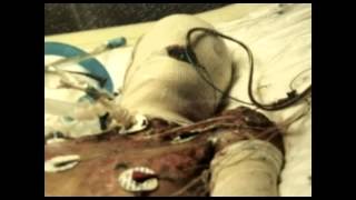 On the Move - Winson Chen, Burn Survivor  s