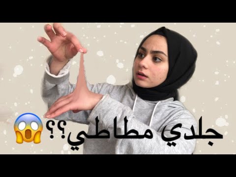 طلعت المرأه المطاطية حقيقه؟😱|| متلازمة اهلرز دانلوس|| Ehlers danlos syndrome|| طالبة طب 📚