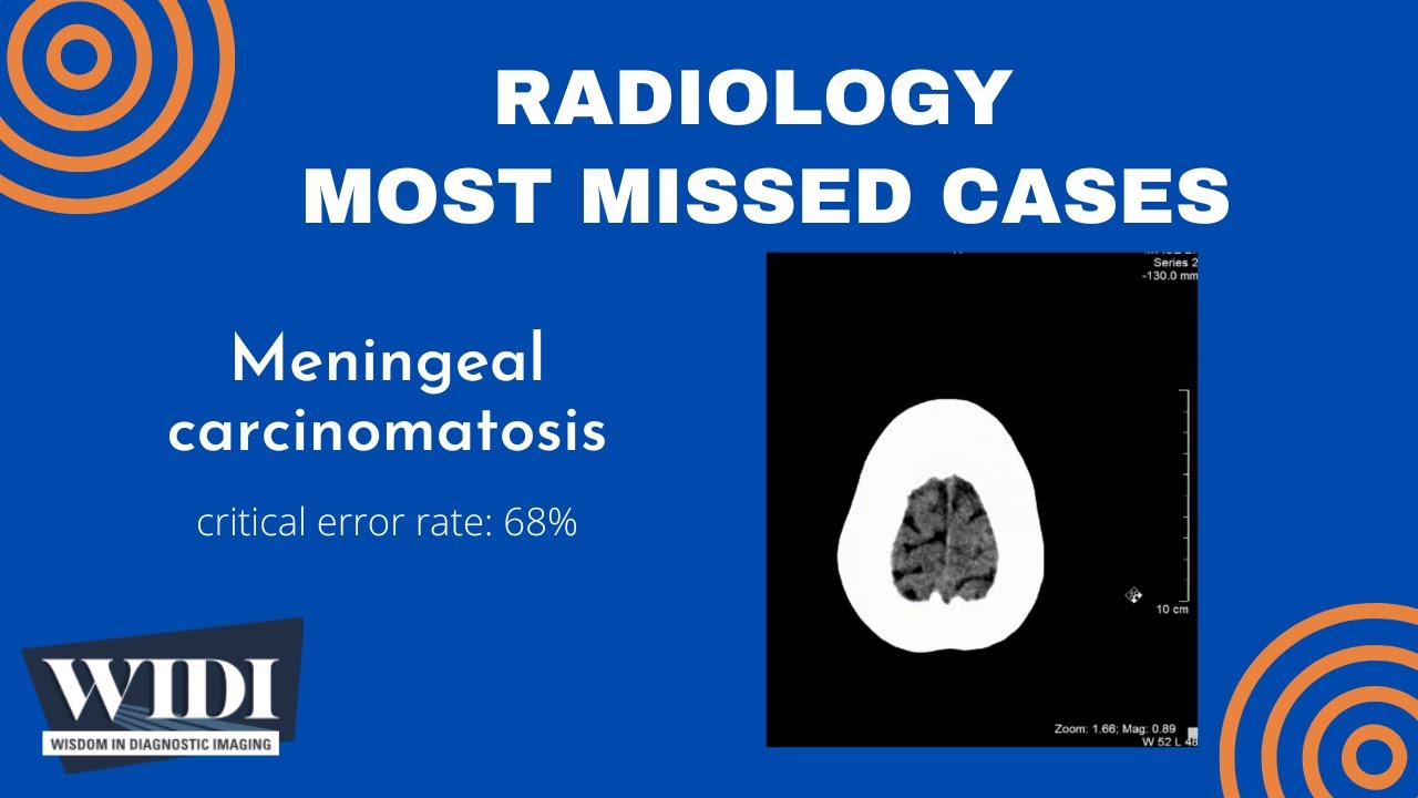 Most Missed Cases: Meningeal carcinomatosis