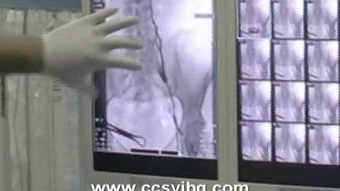 Liberation treatment in medical centre CCSVI BG, Varna