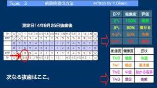 歯周病3　歯周検査表の見方-４年間に５本の歯を失って