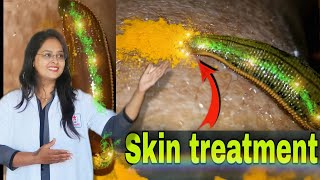 Ye kya hai? | Jalauka avacharan | Leech therapy | #ayurveda #skinproblems #youtube