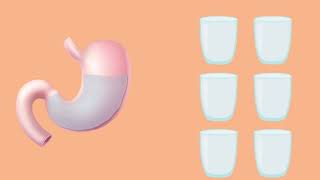 Tüp Mide Ameliyatı Op. Dr. Müslüm Tarkan Resimi