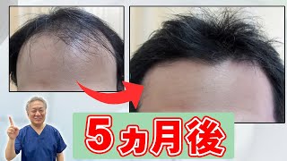 まだ間に合うAGA治療！その薄毛、治ります！【薄毛治療】【美容皮膚科】