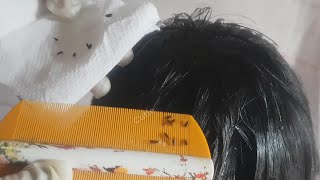 Thousand Lice Removal On Head, Picking Louse From Hair Part 05