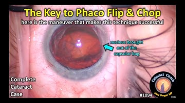 CataractCoach 1094: the key to success with phaco flip and chop