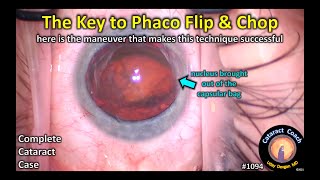 CataractCoach 1094: the key to success with phaco flip and chop screenshot 2