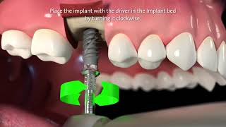 Straumann® TLX Implant System Step by Step Video