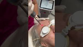 Pigmentation removal l Newcastle Cosmetic Doctor | Removal of large sunspot from forehead with laser screenshot 4