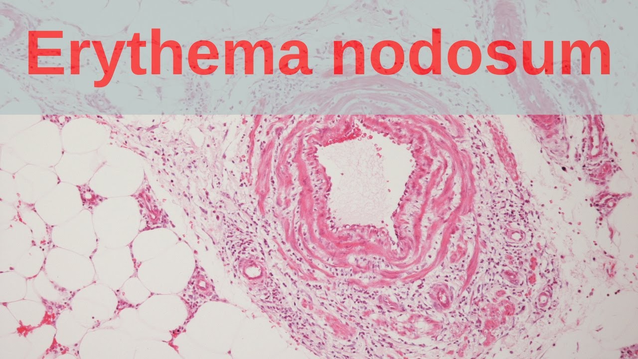 erythema nodosum
