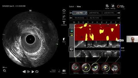 WEBINAR: Innovations in Clinical Use of IVUS+NIRS Imaging