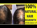 बाल वापस उगाने का 100% नैचुरल तरीका । 100% NATURAL HAIR REGROWTH POWDER I  DR. MANOJ DAS