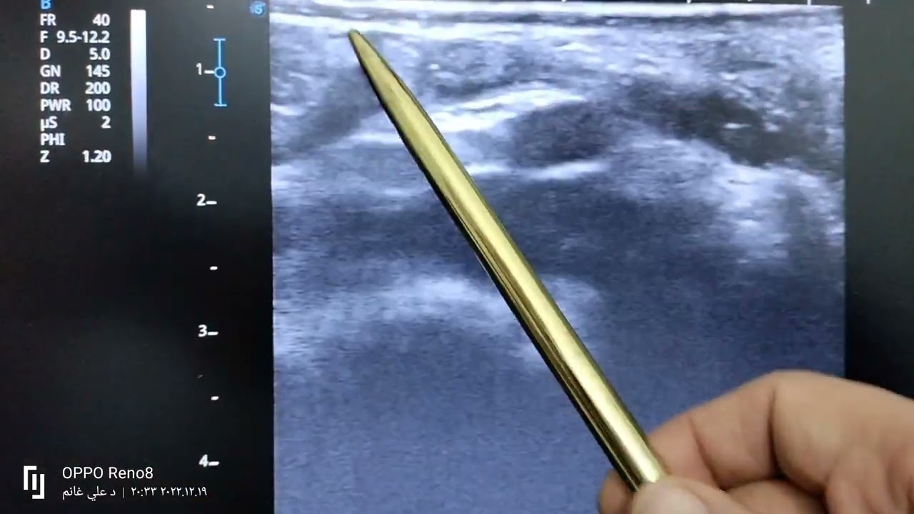 شرح السونار وازاي نعرف نطلع الزايده normal appendix landmarks