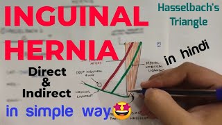 Inguinal Hernia Anatomy (1/2) | Direct and Indirect Inguinal Hernia | Abdomen | Anatomy